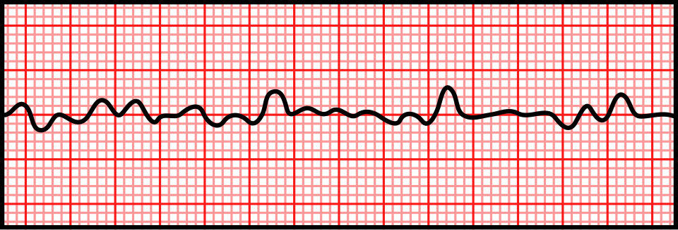 ECG strip showing ventricular fibrillation