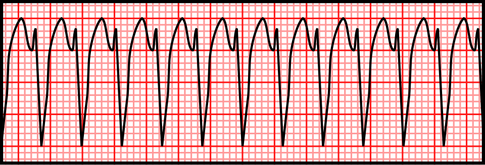 ECG strip showing ventricular tachycardia