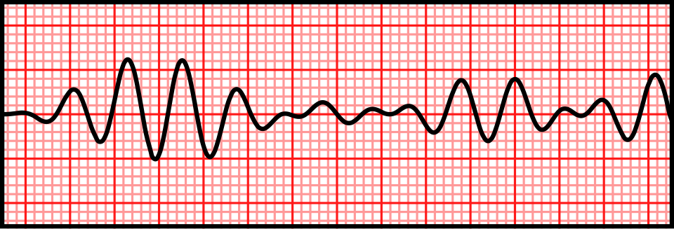 ECG strip showing torsades de pointes