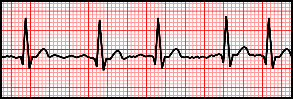 ECG strip showing atrial fibrillation
