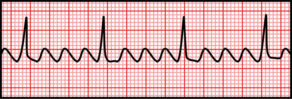 ECG strip showing atrial flutter