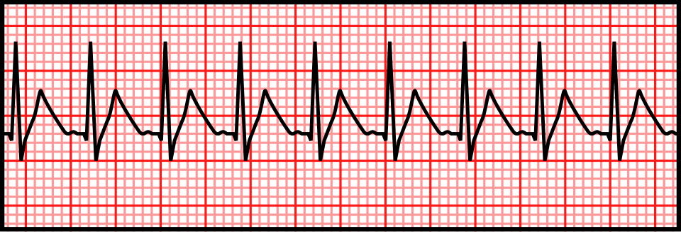 ECG strip showing supraventricular tachycardia