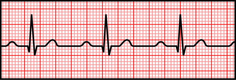 ECG showing First-degree AV block