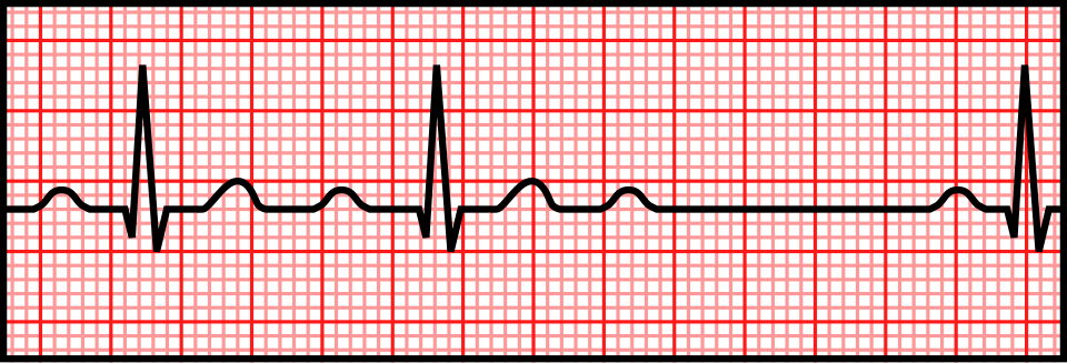 ECG showing Mobitz I (Wenckebach)