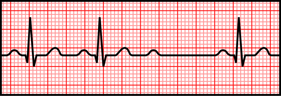 ECG showing Mobitz II