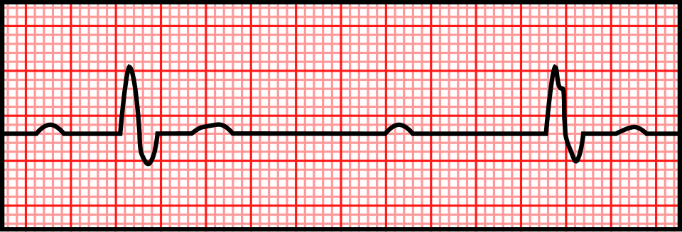 ECG showing Complete heart block