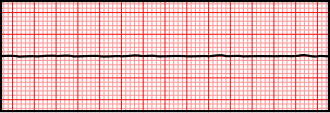 ECG strip showing asystole