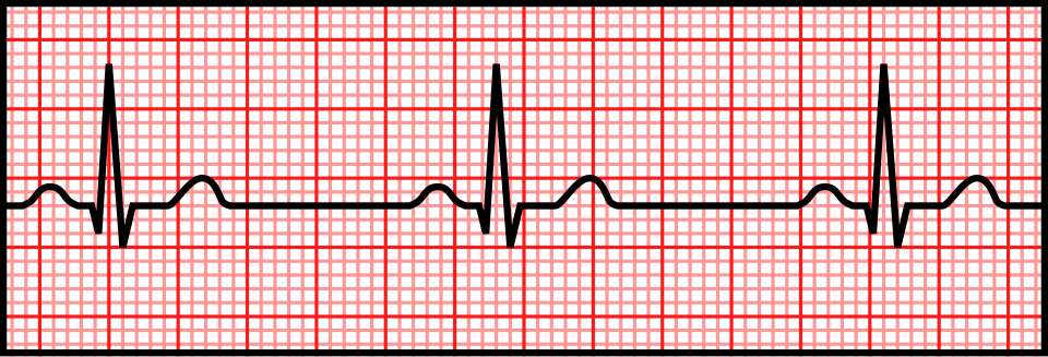 ECG strip showing sinus bradycardia