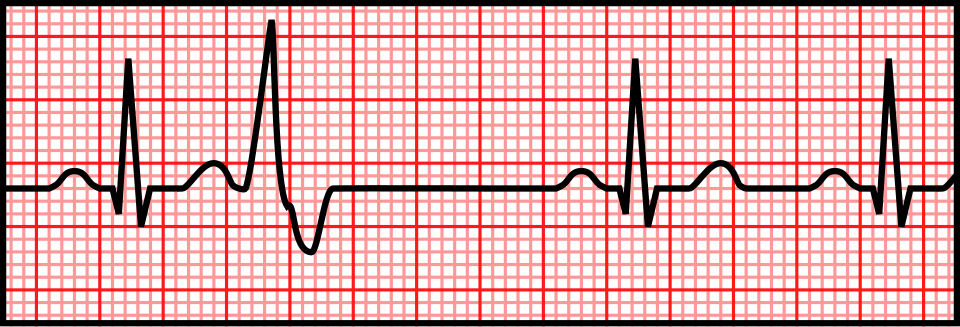 ECG strip showing a premature ventricular complex