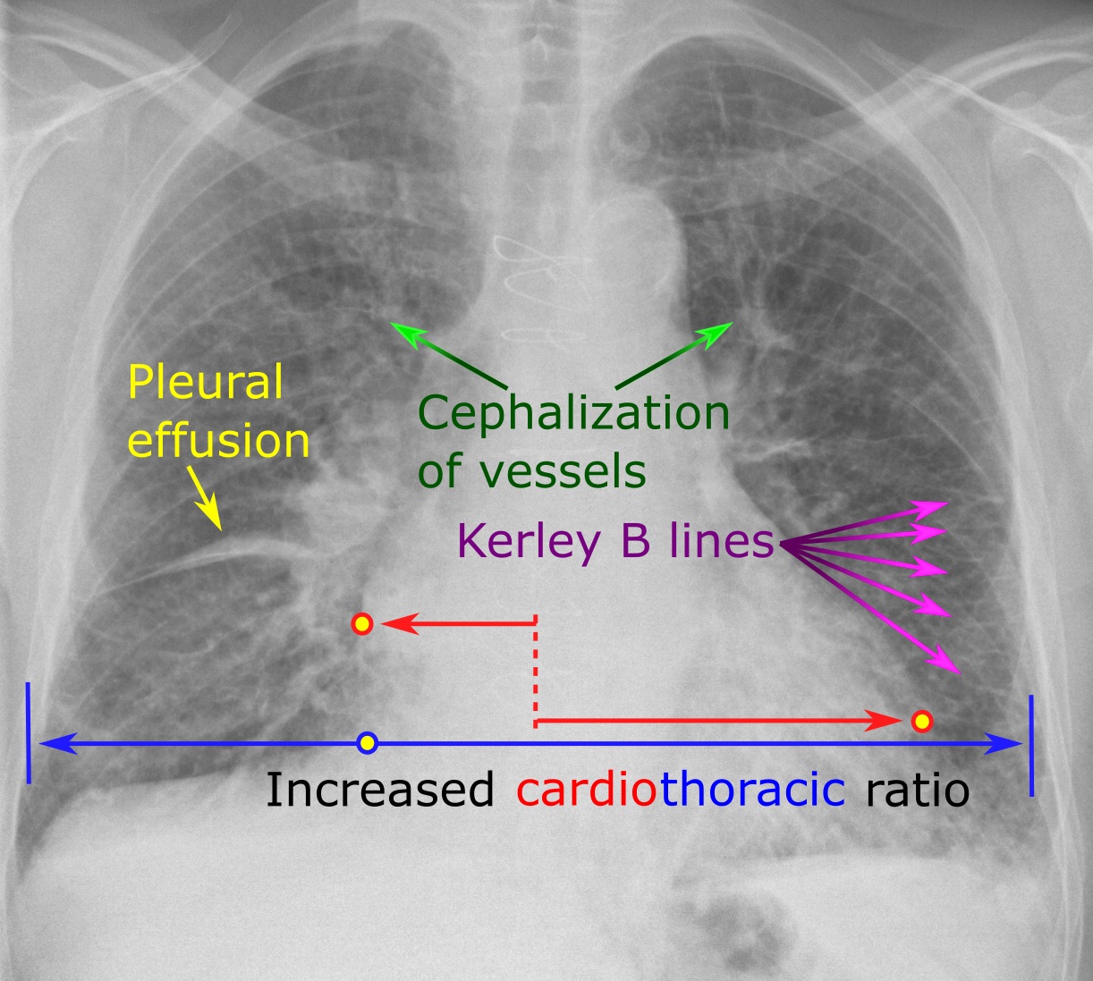 Annotated chest radiograph of congestive heart failure showing increased cardiothoracic ratio, cephalisation, Kerley B lines and a small pleural effusion