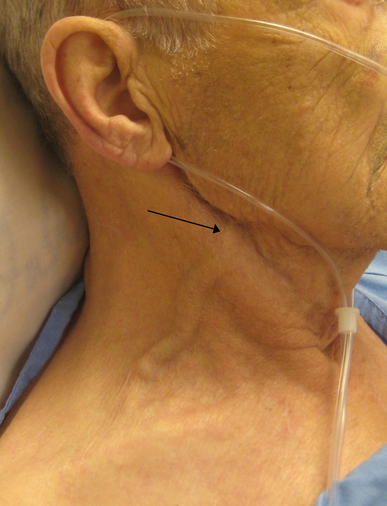 Clinical photograph showing markedly elevated jugular venous pressure in a patient with congestive heart failure