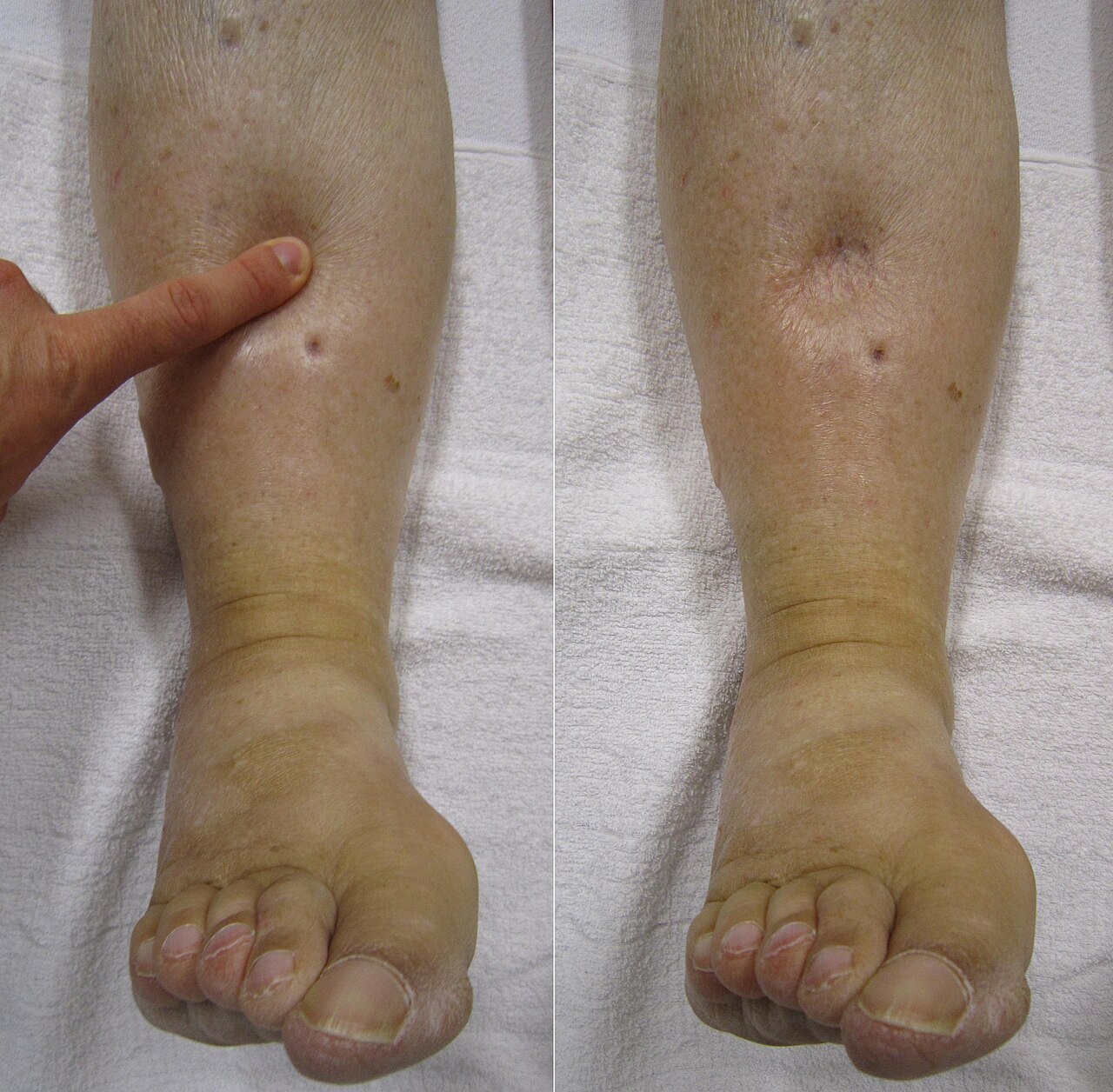 Clinical photograph demonstrating pitting peripheral oedema before and after pressure is applied to the lower leg